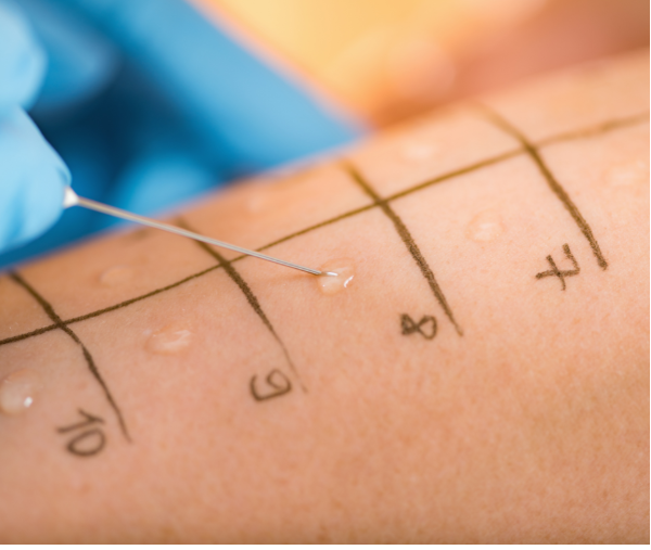 What Do They Test for in Allergy Skin Test - Trusty Med Clinic