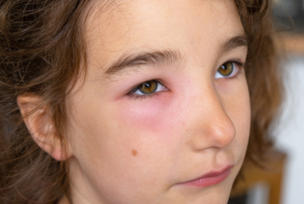 How to Get Rid of a Swollen Eye From Allergies Quickly