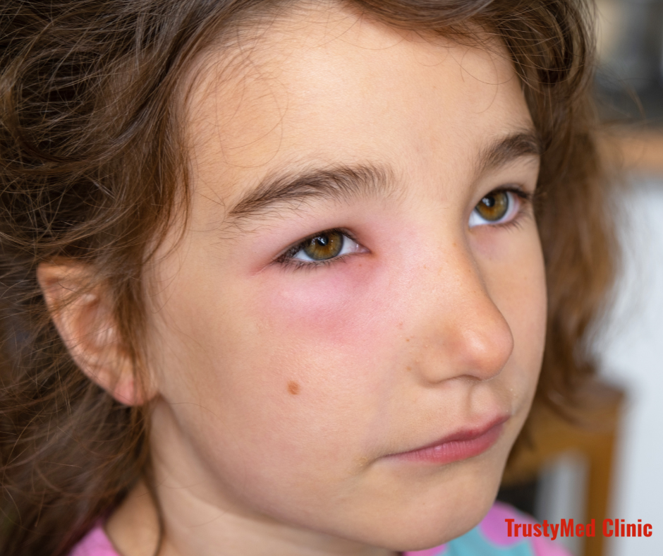 How to Get Rid of a Swollen Eye From Allergies